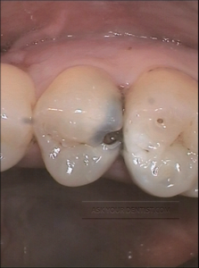 Decayed Tooth