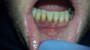 Gum damage due to gum disease