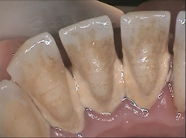 Tartar on Teeth (Dental Calculus): Causes & Removal